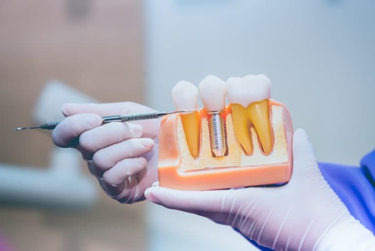 Affordable Dental Implants for Seniors & Low-Income Families: A Practical Guide to Lower-Cost Care in 2025